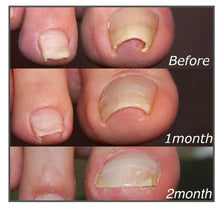 Load image into Gallery viewer, Easy Patches - Correction Patches For Beautiful And Healthy Nails