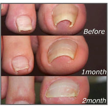 Load image into Gallery viewer, Easy Patches, Correction Patches For Beautiful And Healthy Nails