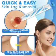 Load image into Gallery viewer, Auto Skin Tag Remover Painless
