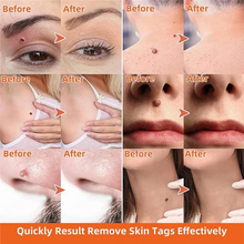 Load image into Gallery viewer, Auto Skin Tag Remover Painless
