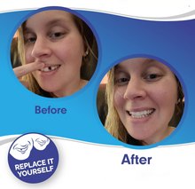 Load image into Gallery viewer, Clip On Veneer Shell with Custom Molded Silicone Strip for Upper Teeth
